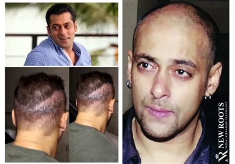 salman khan hair transplant